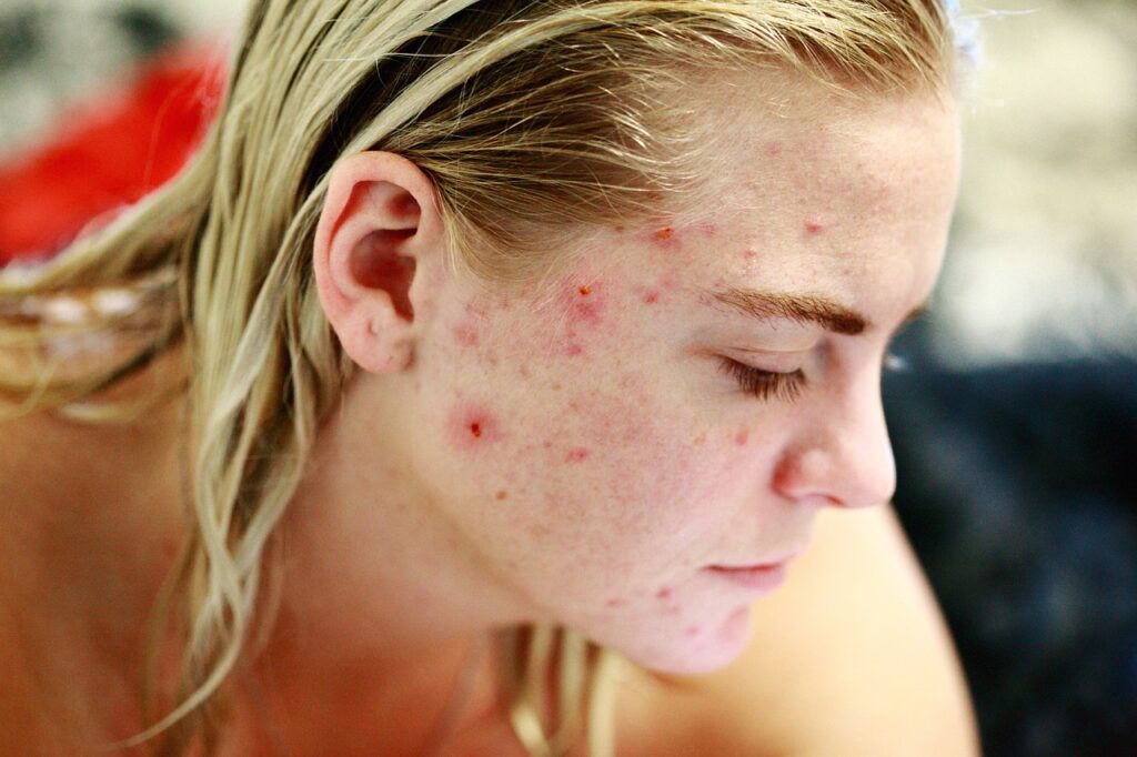 struggle, acne, self love-3805349.jpg